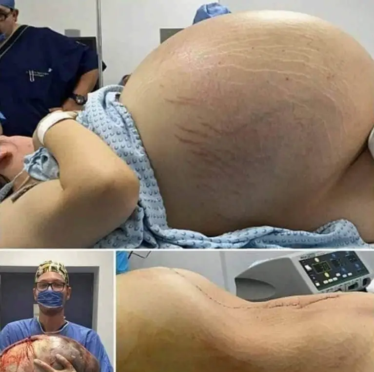 Tears of Joy Turn to Shock: A Pregnant Woman Expecting Triplets Leaves Doctors Stunned by Terrifying Discovery During C-Section